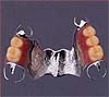 入れ歯　義歯の作成