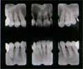 歯のレントゲンの写真