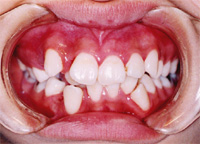 歯列矯正前の写真